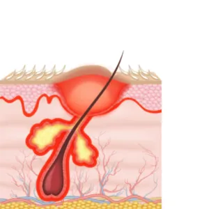 Pathogenesis Causes of Acne