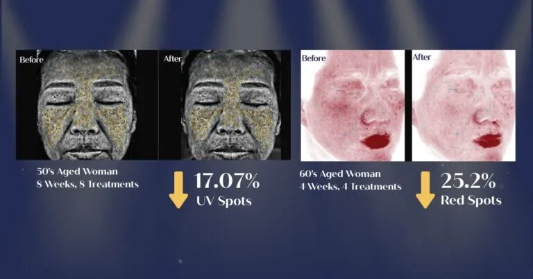 DEEP SHOOT LUMI Clinical Results