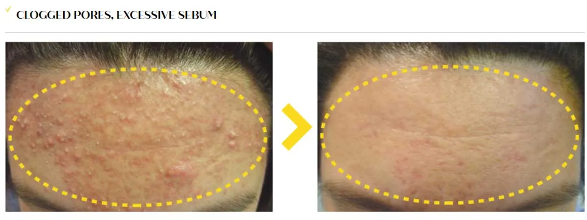 Clinical Trial
