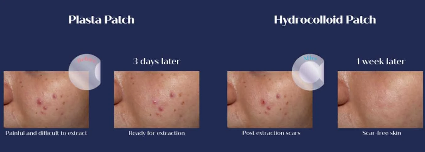 Dermatologist approved Plasta Patch